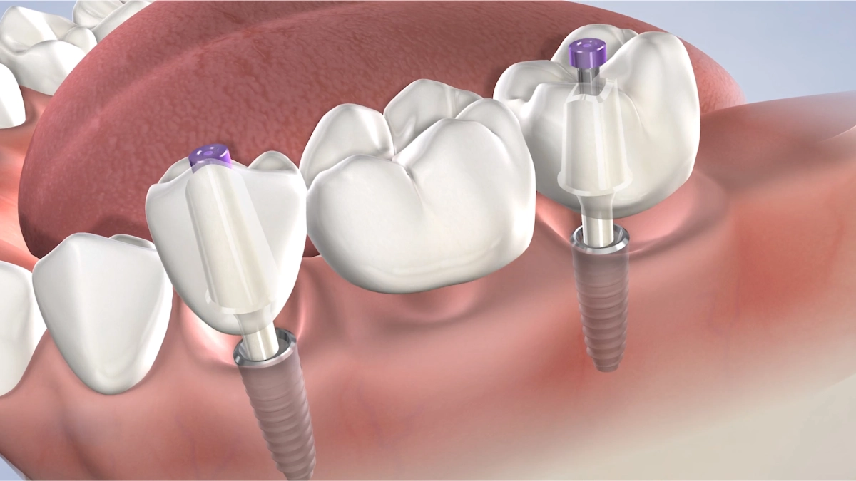 instructions-post-operative-dental-implants